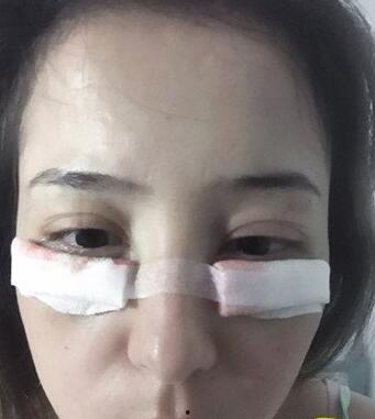 去眼袋手术过程视频,专业解析与真实体验